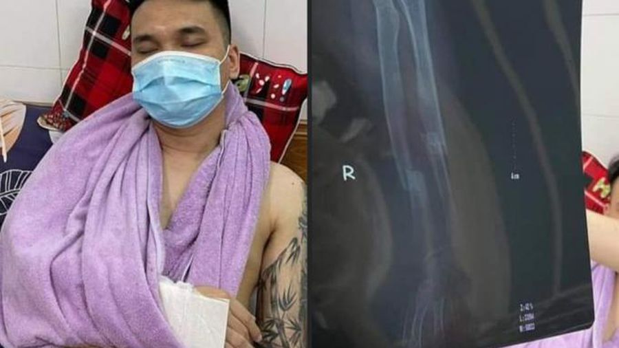 Khắc Việt chấn thương ở tay vào chiều qua